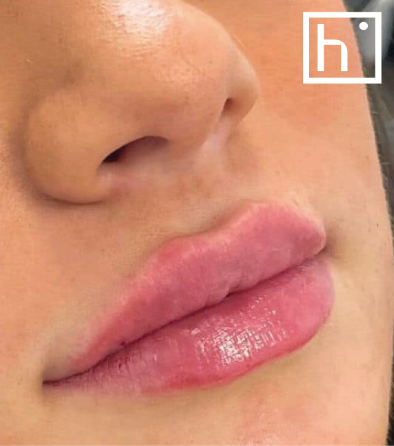 Augmentation des lèvres après - hapiderm geneve