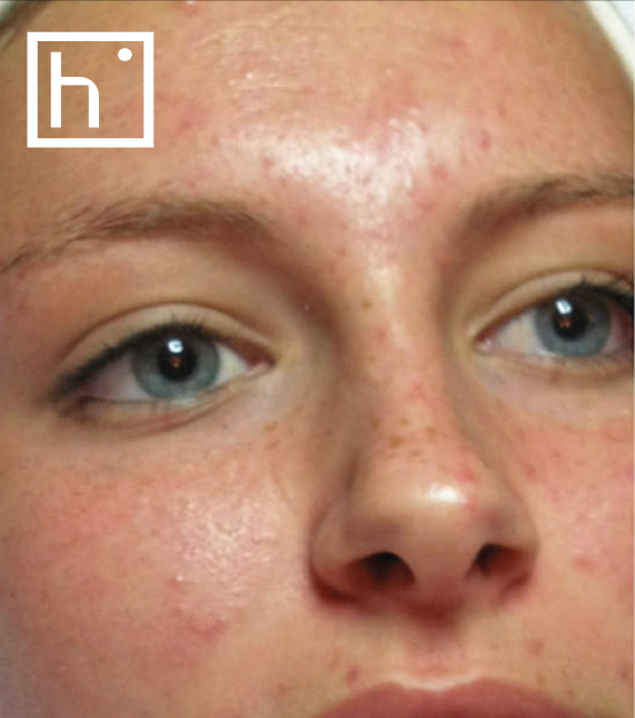 Hydrafacial acne after