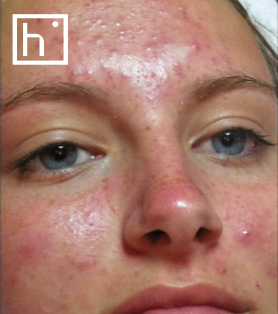 Hydrafacial acne before