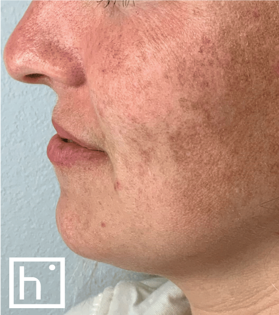 Lumecca taches pigmentaires visage avant