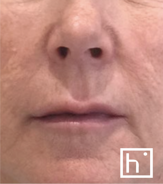Profhilo bouche après - hapiderm Genève