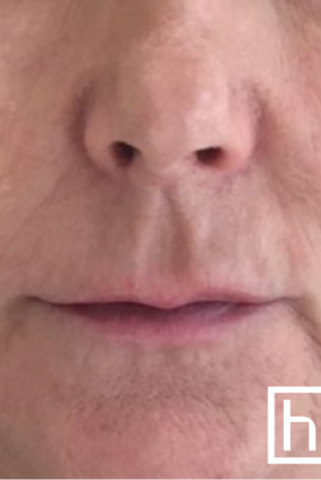 Profhilo bouche avant - hapiderm Genève