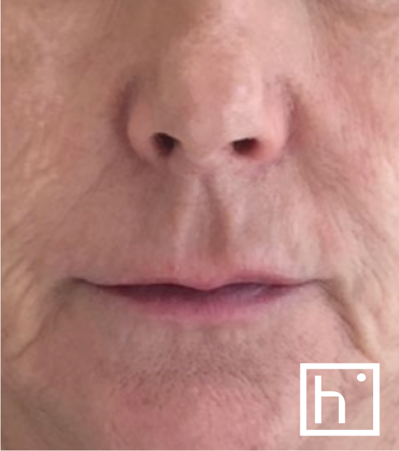 Profhilo bouche avant - hapiderm Genève