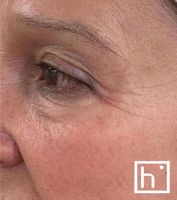 Profhilo oeil après - hapiderm Genève