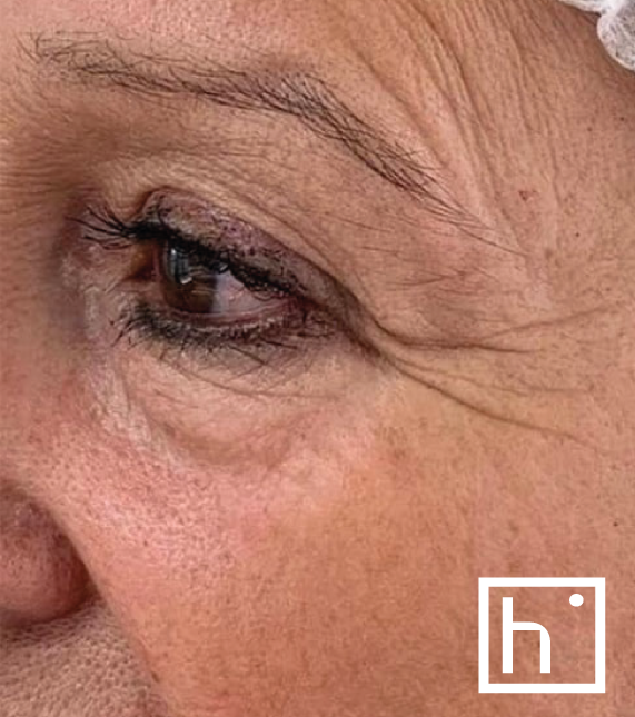 Profhilo oeil avant - hapiderm Genève