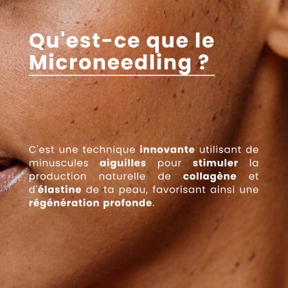 Qu'est ce que le microneedling info