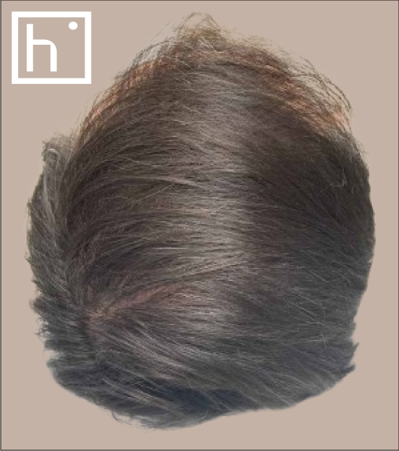 Mésothérapie capillaire - après - hapiderm Genève