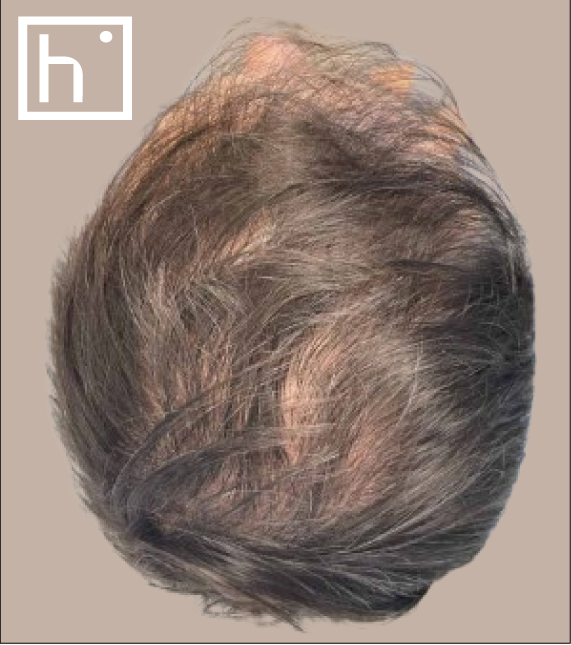 Mésothérapie capillaire - avant - hapiderm Genève